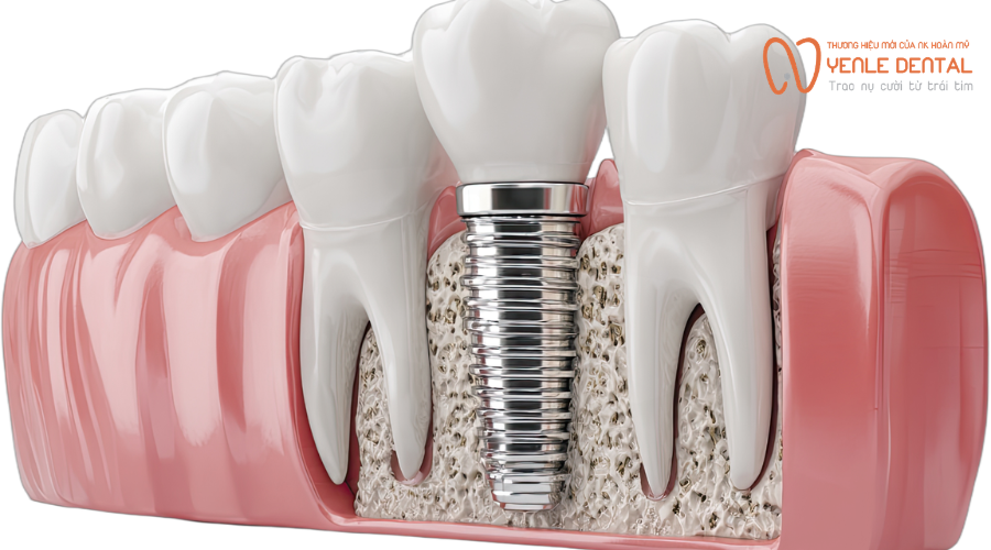 trồng răng Implant